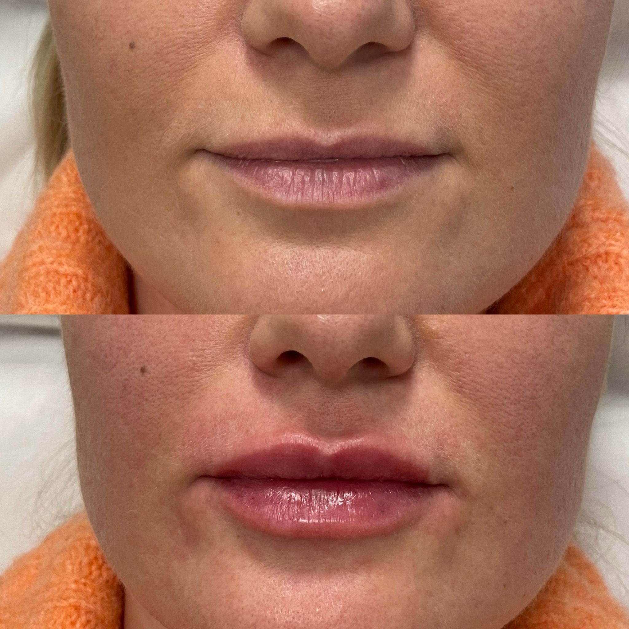 Lip Filler London: An Editorial Guide to Natural Lip Enhancement & Refined Lip Augmentation