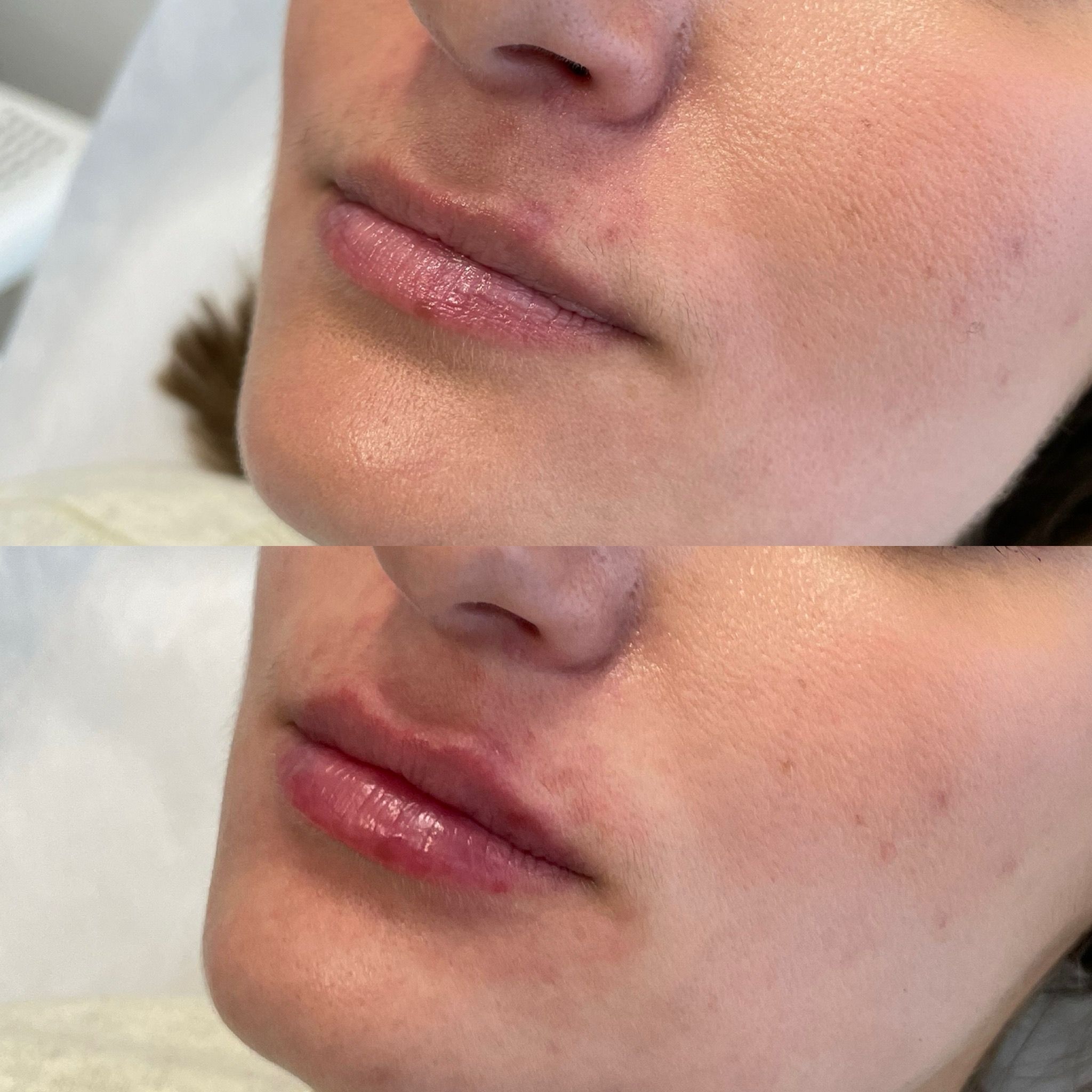 Lip Filler London: An Editorial Guide to Natural Lip Enhancement & Refined Lip Augmentation