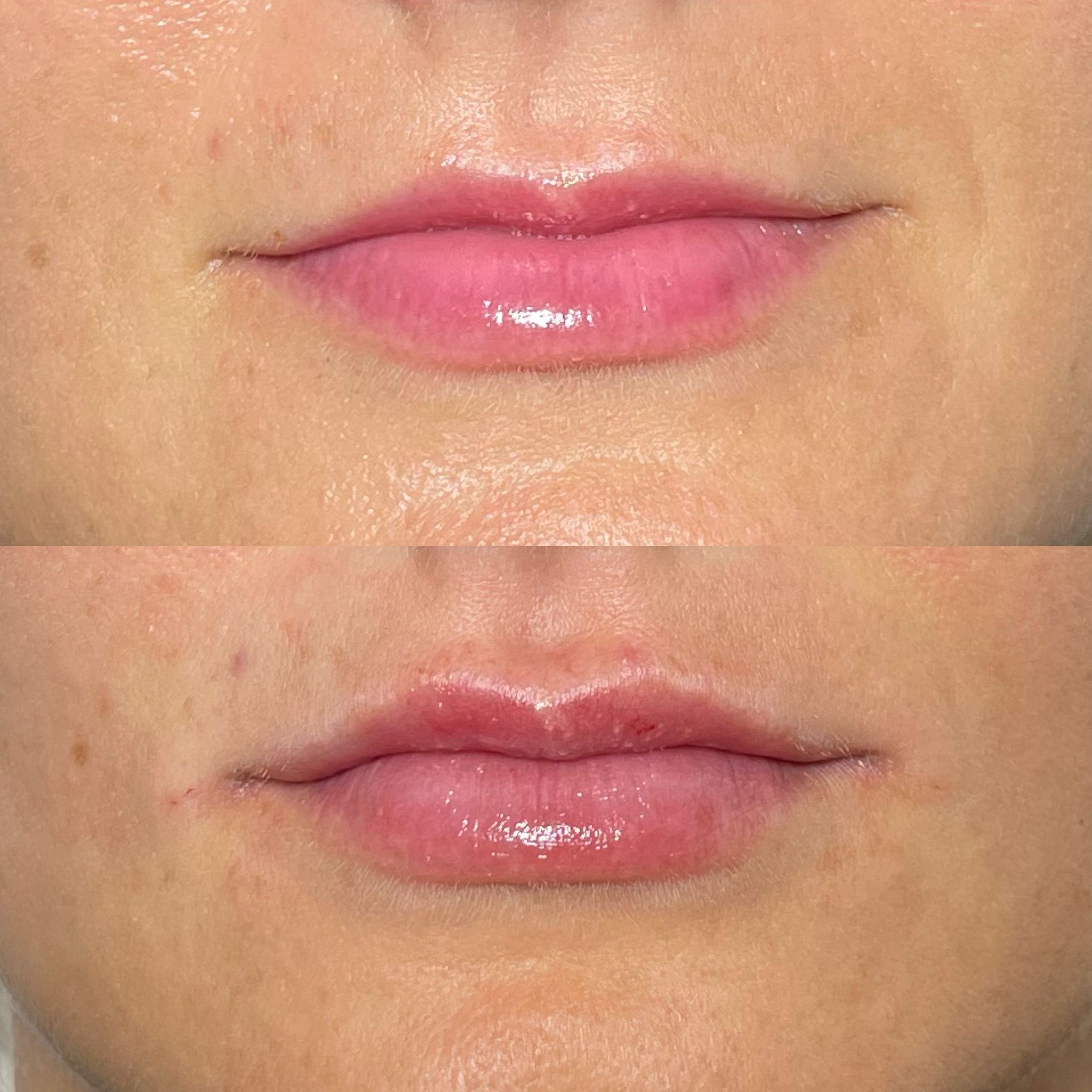Lip Filler London: An Editorial Guide to Natural Lip Enhancement & Refined Lip Augmentation
